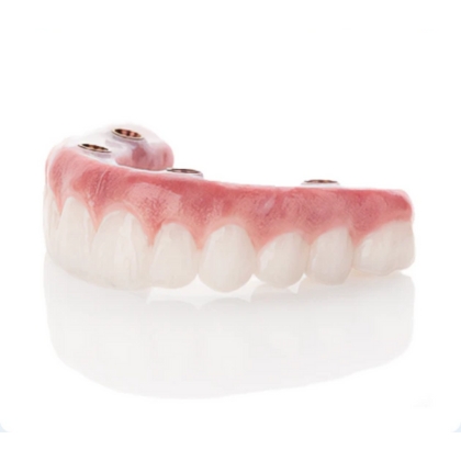 Fixed full arch dental implant model showing complete upper teeth restoration on four implants – Boulder, CO