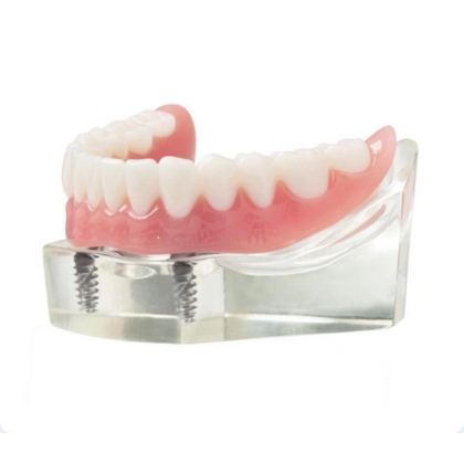 Implant denture model showing snap-in overdenture secured on dental implants – Boulder, CO