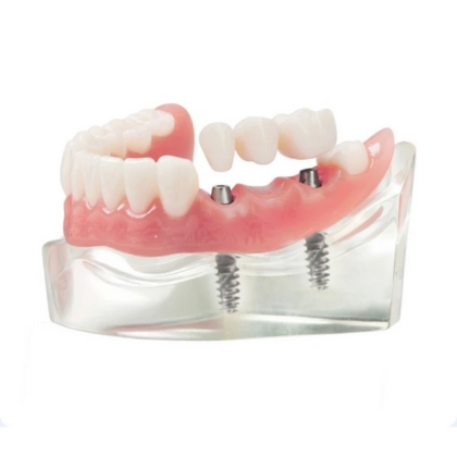 Implant-supported bridge model showing multiple dental implants with attached prosthetic teeth – Boulder, CO