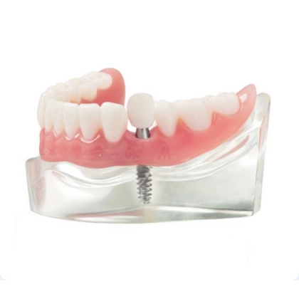 Single tooth dental implant model showing titanium post and crown replacement for missing tooth – Boulder, CO