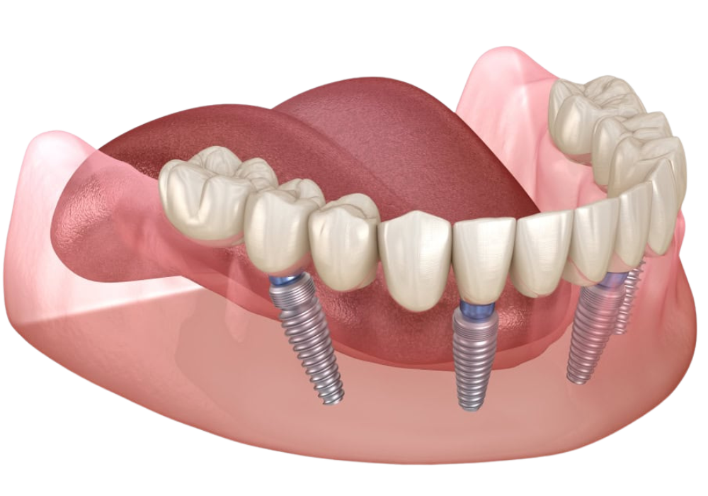 All-on-4 dental implants full arch restoration | Dental Implants Boulder CO