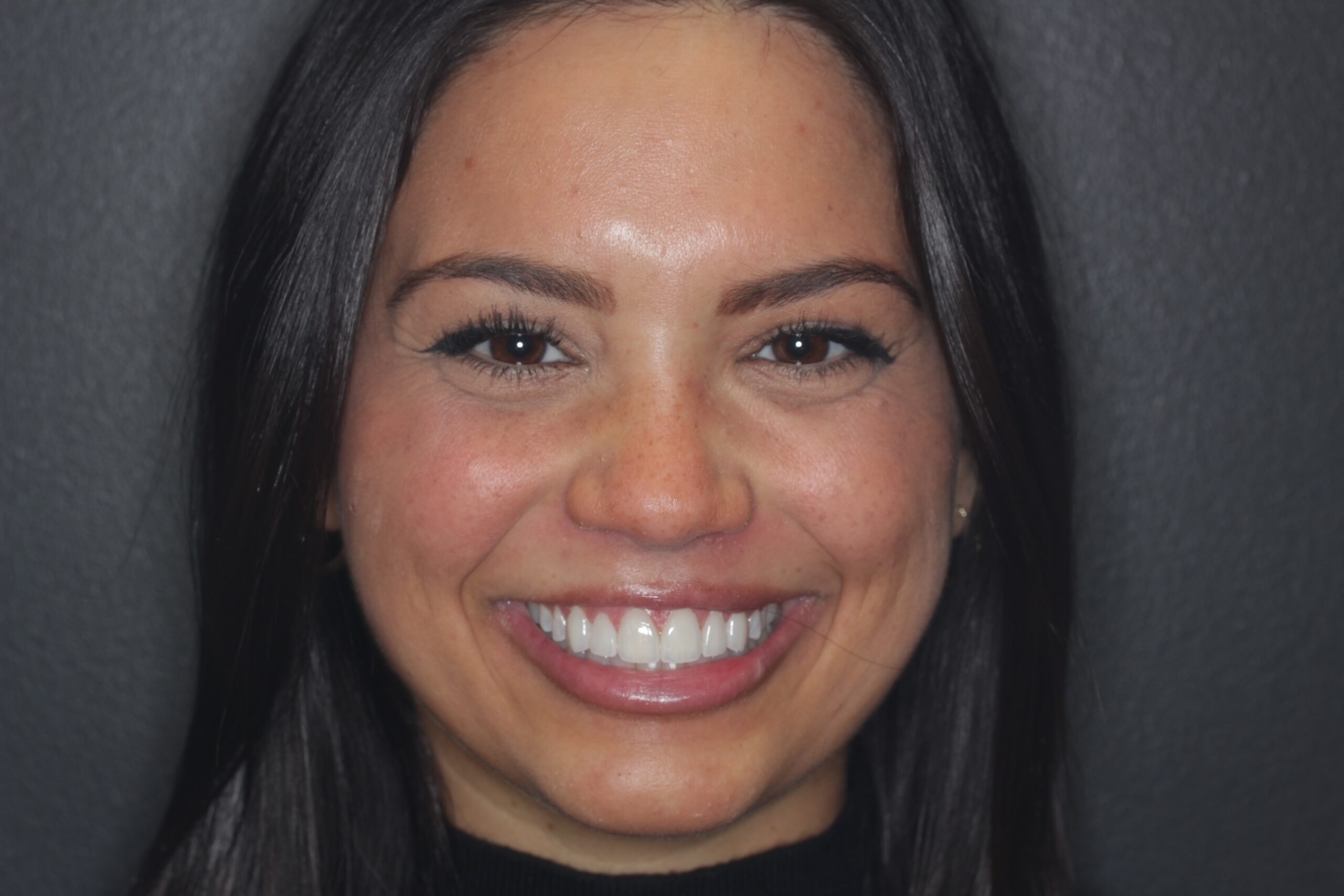 After smile transformation with natural, bright, and symmetrical teeth – Boulder, CO