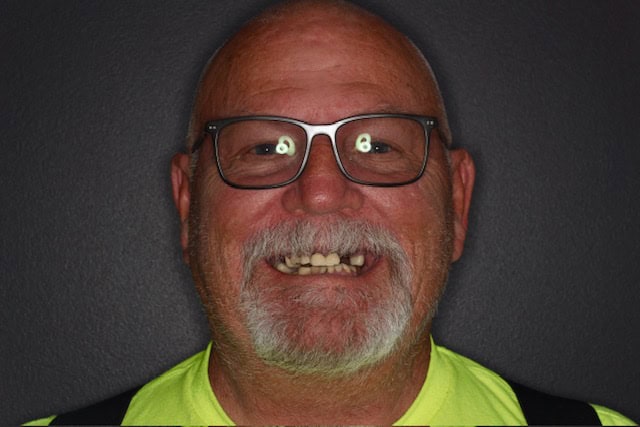 image3 Before dental implant treatment showing missing upper teeth – Boulder, CO