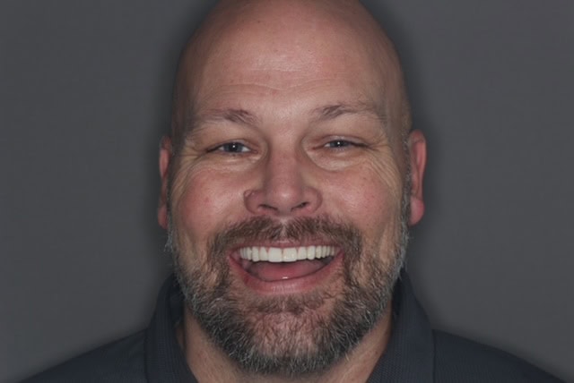 After full arch dental implants with restored teeth and improved smile – Boulder, CO