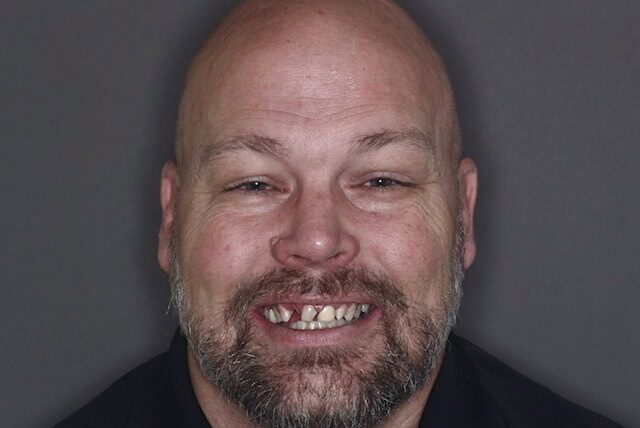 retouch-before-e1755270842197 Before full arch dental implants showing tooth loss and worn dentition – Boulder, CO