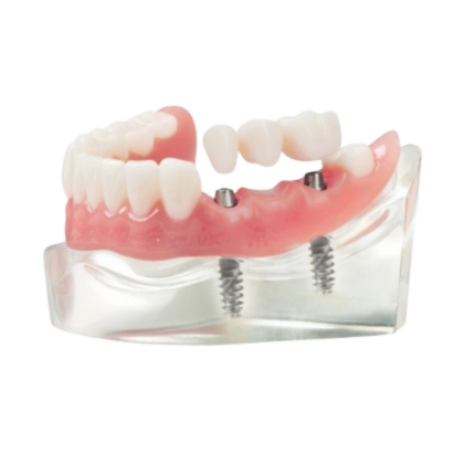 Transparent_Bridge_Implant