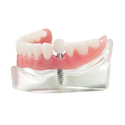Transparent_Single_Implant